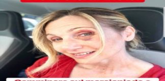 Per colpa di una buca: la caduta di Lorella Cuccarini, che venerdi’ ha rimediato un occhio pesto