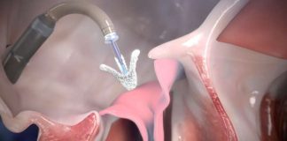 Il Policlinico Rodolico – S. Marco di Catania primo centro in Sicilia e tra i primi in Italia per numero di procedure effettuate per la riparazione della valvola cardiaca tricuspide, nei soggetti che soffrono di un’insufficienza clinicamente rilevante dovuta a questa valvola: un primato per l’équipe di emodinamica che ha già trattato 11 casi, il numero più alto a livello regionale e tra i più significativi nel Paese