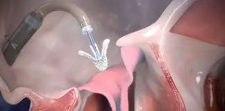 Il Policlinico Rodolico – S. Marco di Catania primo centro in Sicilia e tra i primi in Italia per numero di procedure effettuate per la riparazione della valvola cardiaca tricuspide, nei soggetti che soffrono di un’insufficienza clinicamente rilevante dovuta a questa valvola: un primato per l’équipe di emodinamica che ha già trattato 11 casi, il numero più alto a livello regionale e tra i più significativi nel Paese