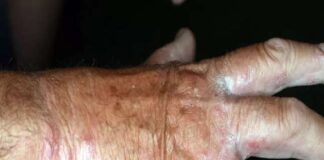 La Fiadel, a firma di Clara Crocè, scrive all’Asp di Messina denunciando che al locale Istituto Don Orione… “è venuta a conoscenza che tre operatori sono affetti dalla Scabbia”