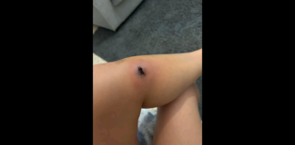 Venezia, 25enne morsa da un ragno violino: la donna ha raccontato su Facebook di essere stata morsa in casa, a Marghera… “Per fortuna ho preso l’infezione in tempo sennò sarebbe stato, in base a quello che mi hanno riferito i dottori, addirittura mortale… è pericoloso, andate subito all’ospedale”