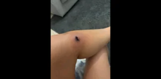Venezia, 25enne morsa da un ragno violino: la donna ha raccontato su Facebook di essere stata morsa in casa, a Marghera… “Per fortuna ho preso l’infezione in tempo sennò sarebbe stato, in base a quello che mi hanno riferito i dottori, addirittura mortale… è pericoloso, andate subito all’ospedale”