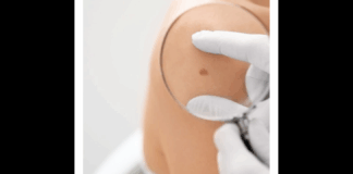 L’UOC di Dermatologia dell’AOU Policlinico «Gaetano Martino» di Messina (diretta dal Prof. Fabrizio Guarneri), anche quest’anno parteciperà all’iniziativa «Save your skin», prevista per sabato 24 Maggio, dalle 9 alle 13: in tale occasione sarà possibile ricevere consulti e visite gratuite; è necessario prenotare tramite il call center dedicato, operativo dal 5 Maggio, 7 giorni su 7, dalle 08.30 alle 19.30, al numero 800 991126